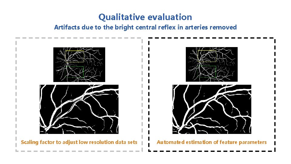 Qualitative evaluation Artifacts due to the bright central reflex in arteries removed Scaling factor