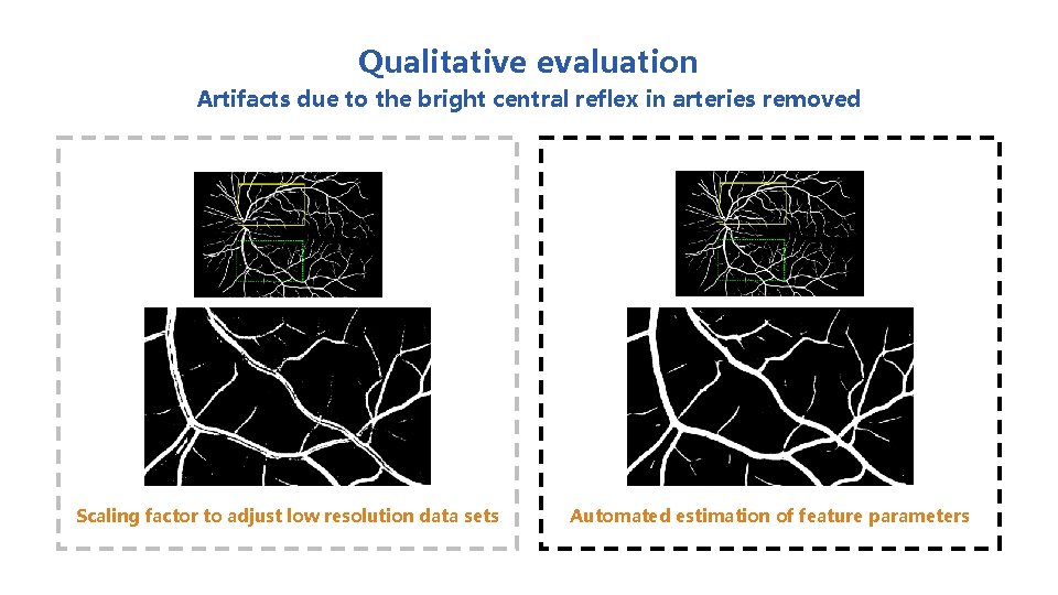 Qualitative evaluation Artifacts due to the bright central reflex in arteries removed Scaling factor