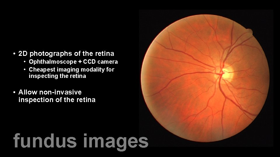 • 2 D photographs of the retina • Ophthalmoscope + CCD camera •