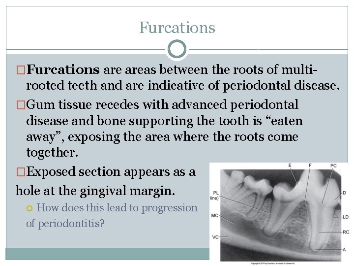 Furcations �Furcations areas between the roots of multi- rooted teeth and are indicative of
