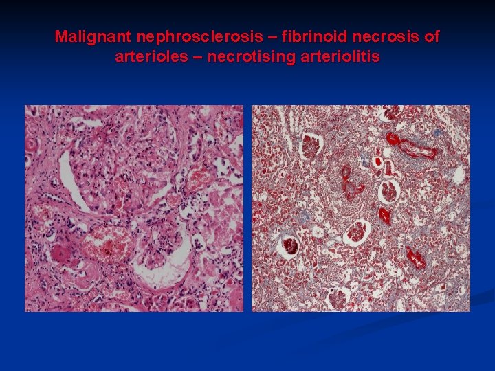 Malignant nephrosclerosis – fibrinoid necrosis of arterioles – necrotising arteriolitis 