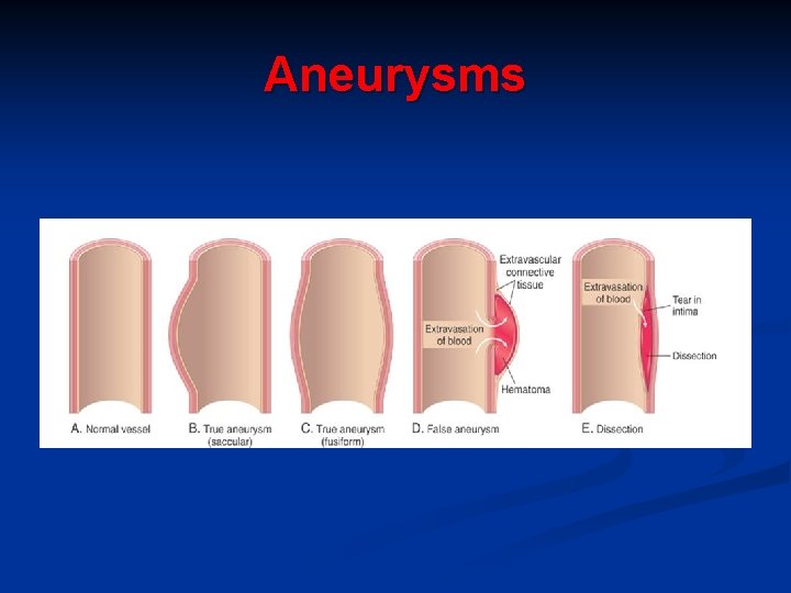 Aneurysms 
