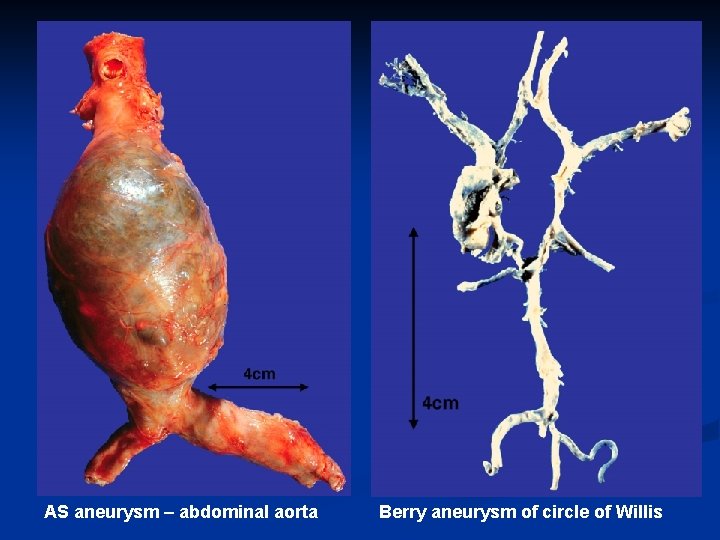 AS aneurysm – abdominal aorta Berry aneurysm of circle of Willis 
