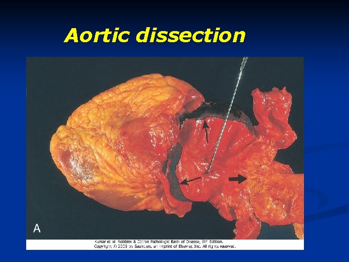 Aortic dissection 