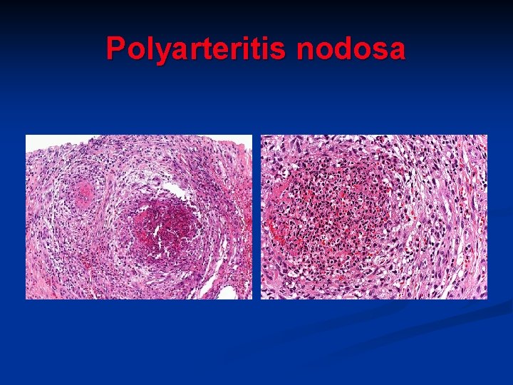 Polyarteritis nodosa 