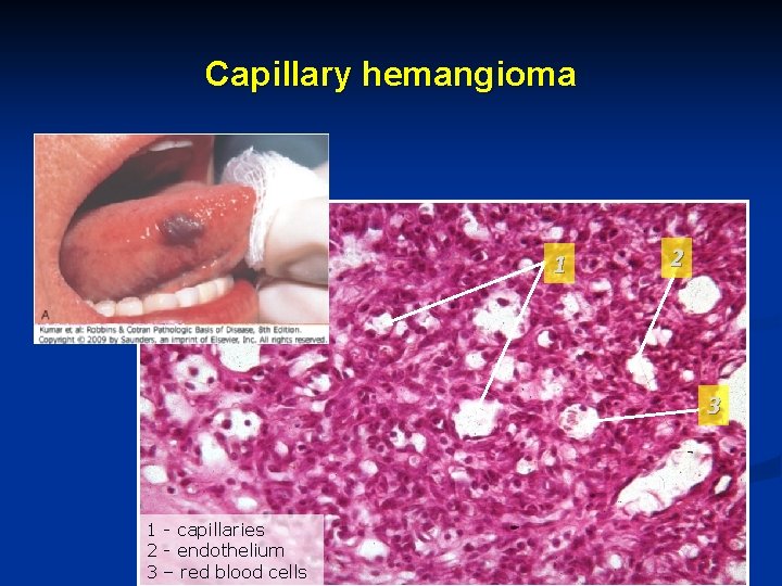 Capillary hemangioma 1 2 3 1 - capillaries 2 - endothelium 3 – red