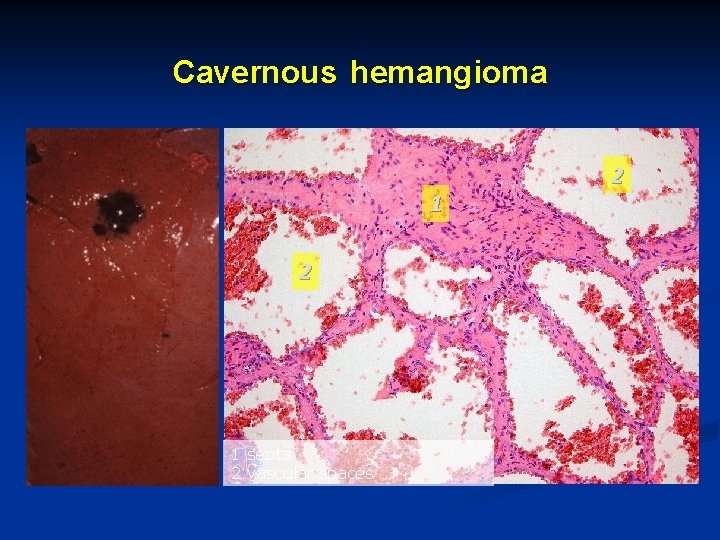 Cavernous hemangioma 1 2 1 septa 2 vascular spaces 2 