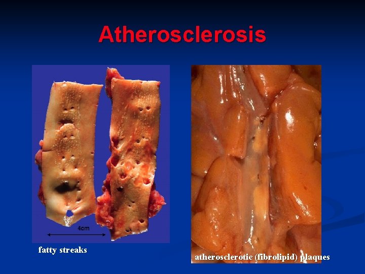 Atherosclerosis fatty streaks atherosclerotic (fibrolipid) plaques 