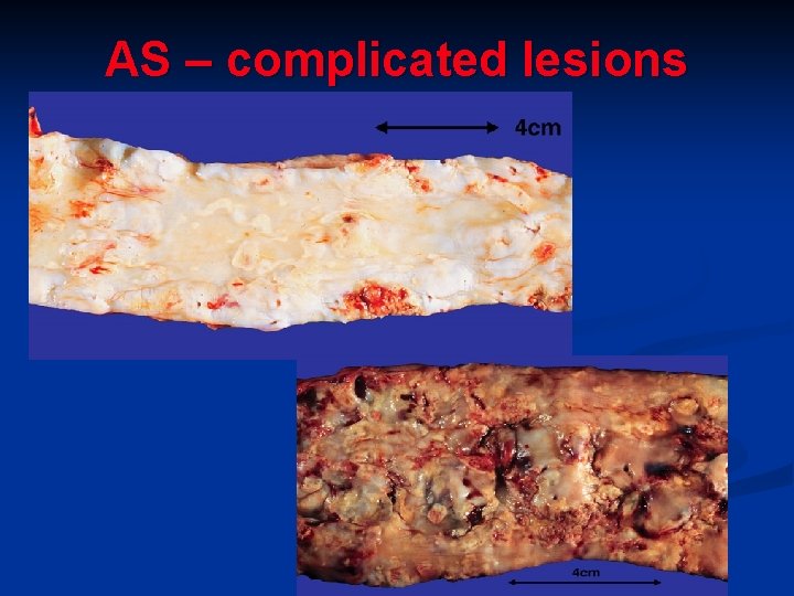 AS – complicated lesions 