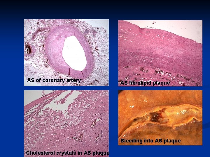 AS of coronary artery AS fibrolipid plaque Bleeding into AS plaque Cholesterol crystals in