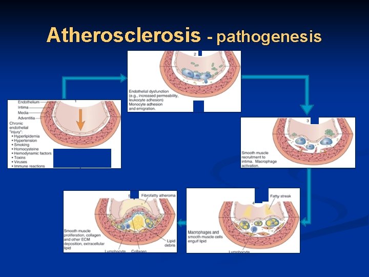 Atherosclerosis - pathogenesis 