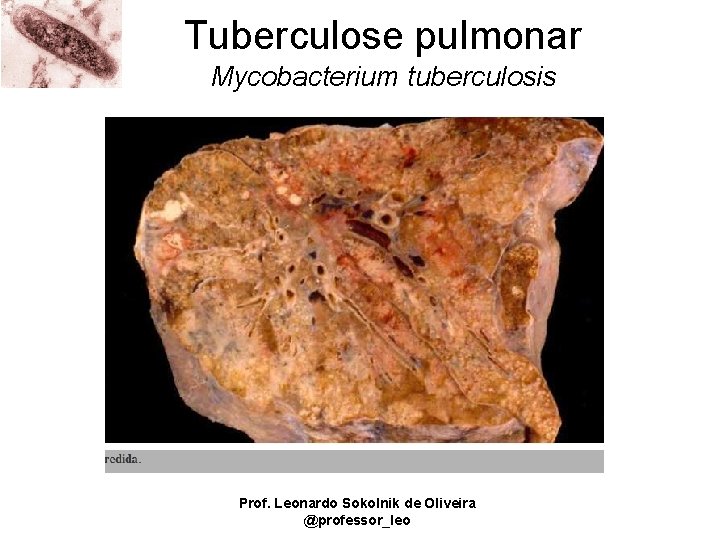 Tuberculose pulmonar Mycobacterium tuberculosis Prof. Leonardo Sokolnik de Oliveira @professor_leo 