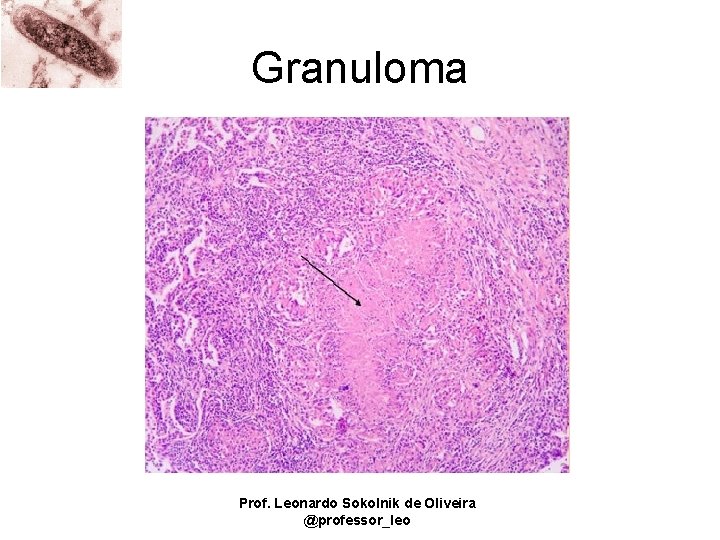 Granuloma Prof. Leonardo Sokolnik de Oliveira @professor_leo 