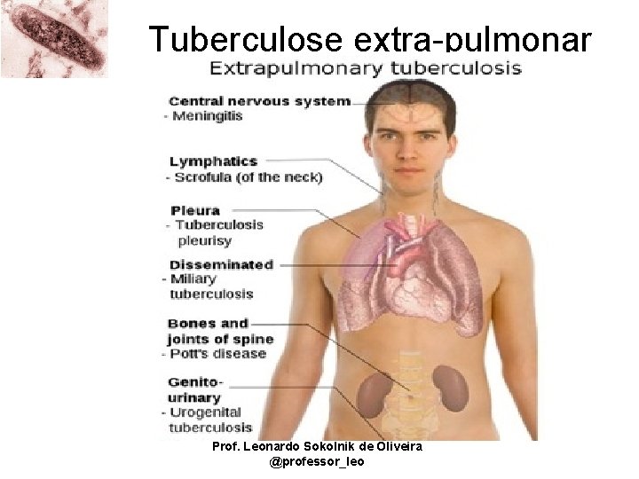 Tuberculose extra-pulmonar Prof. Leonardo Sokolnik de Oliveira @professor_leo 