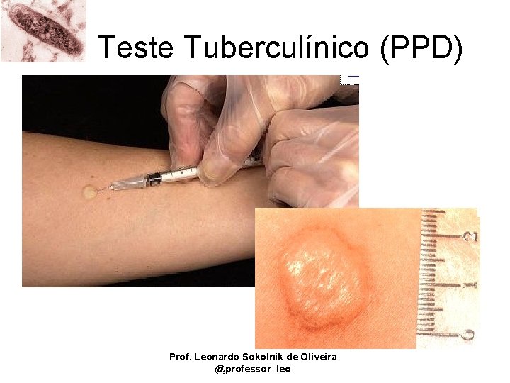 Teste Tuberculínico (PPD) Prof. Leonardo Sokolnik de Oliveira @professor_leo 