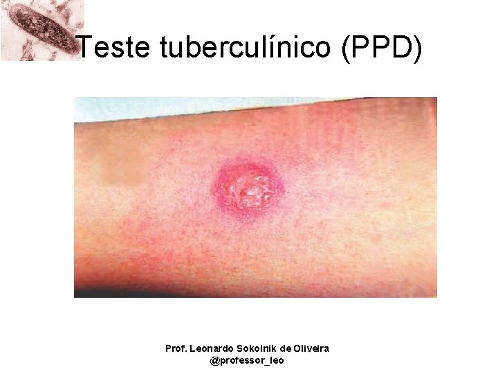 Teste tuberculínico (PPD) Prof. Leonardo Sokolnik de Oliveira @professor_leo 