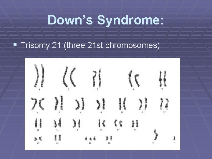 Down’s Syndrome: § Trisomy 21 (three 21 st chromosomes) 