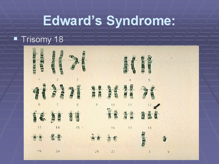 Edward’s Syndrome: § Trisomy 18 