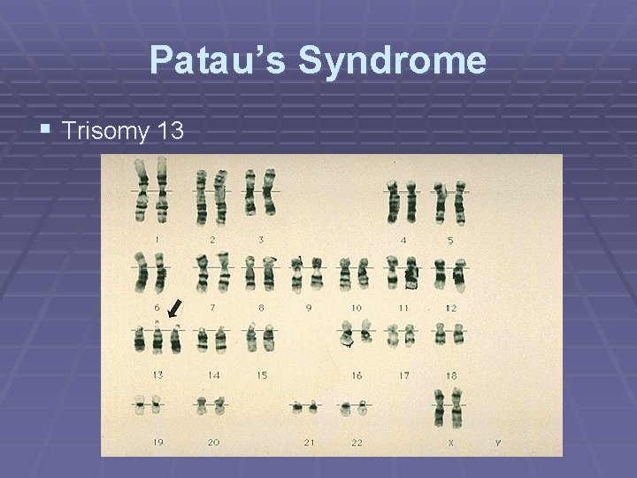 Patau’s Syndrome § Trisomy 13 