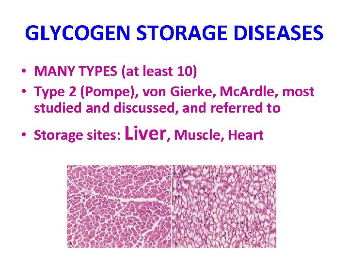 GLYCOGEN STORAGE DISEASES • MANY TYPES (at least 10) • Type 2 (Pompe), von