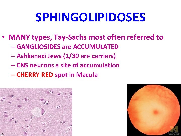 SPHINGOLIPIDOSES • MANY types, Tay-Sachs most often referred to – GANGLIOSIDES are ACCUMULATED –