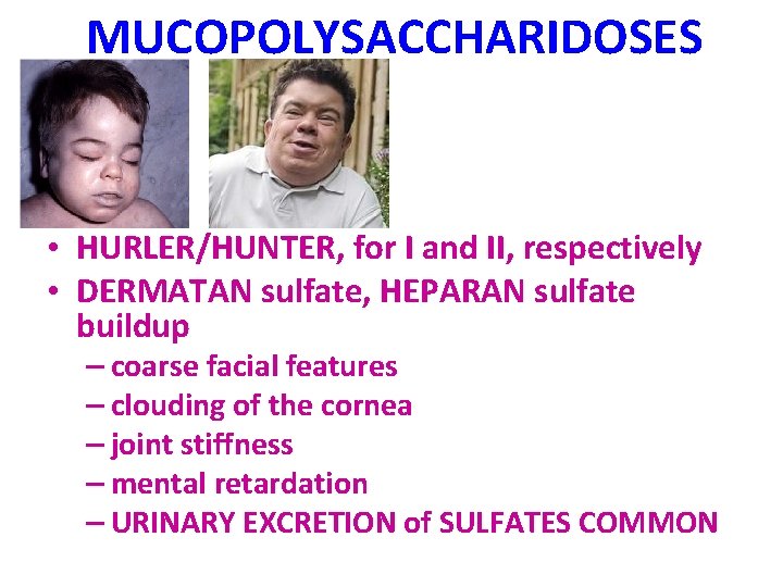 MUCOPOLYSACCHARIDOSES • HURLER/HUNTER, for I and II, respectively • DERMATAN sulfate, HEPARAN sulfate buildup