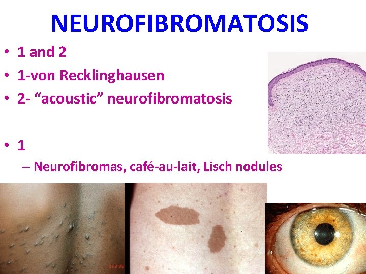 NEUROFIBROMATOSIS • 1 and 2 • 1 -von Recklinghausen • 2 - “acoustic” neurofibromatosis