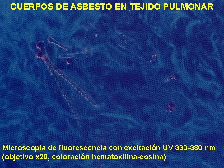 CUERPOS DE ASBESTO EN TEJIDO PULMONAR Microscopia de fluorescencia con excitación UV 330 -380