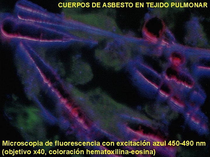 CUERPOS DE ASBESTO EN TEJIDO PULMONAR Microscopia de fluorescencia con excitación azul 450 -490