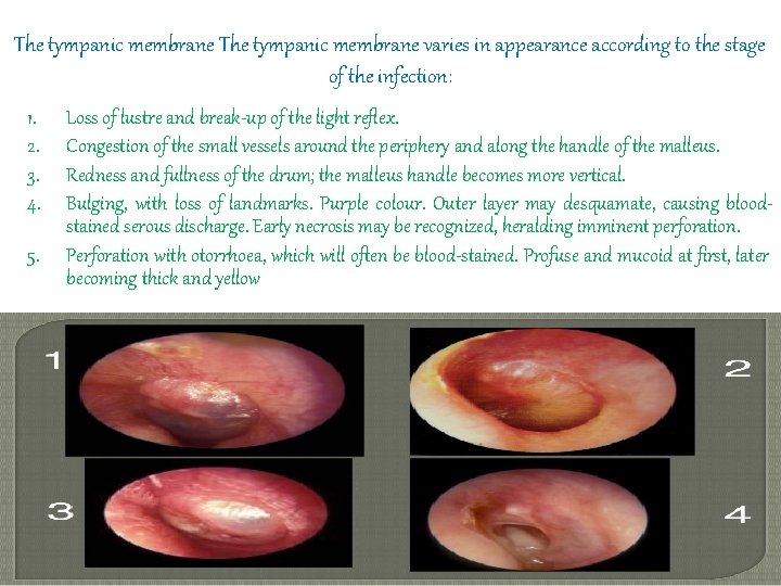 The tympanic membrane varies in appearance according to the stage of the infection: 1.