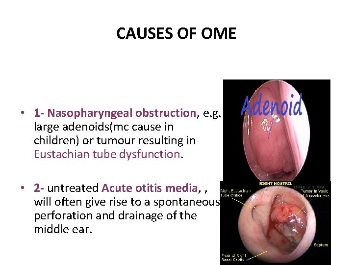 CAUSES OF OME • 1 - Nasopharyngeal obstruction, e. g. large adenoids(mc cause in