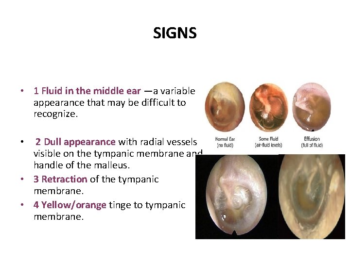 SIGNS • 1 Fluid in the middle ear —a variable appearance that may be