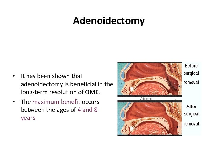 Adenoidectomy • It has been shown that adenoidectomy is beneficial in the long-term resolution