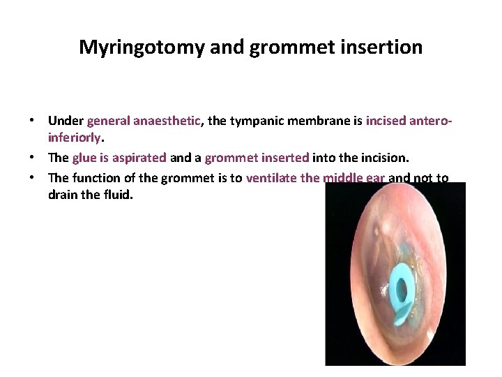 Myringotomy and grommet insertion • Under general anaesthetic, the tympanic membrane is incised anteroinferiorly.