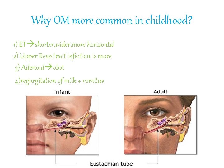 Why OM more common in childhood? 1) ET shorter, wider, more horizontal 2) Upper