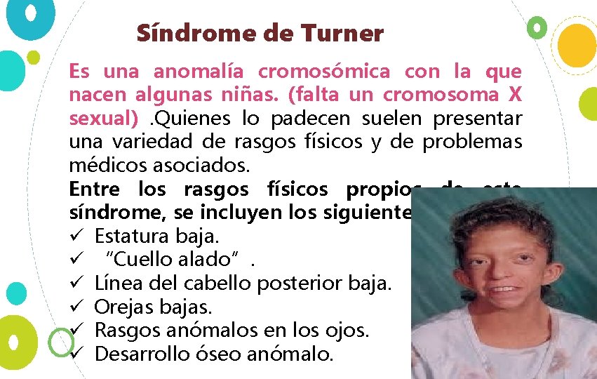 Síndrome de Turner Es una anomalía cromosómica con la que nacen algunas niñas. (falta