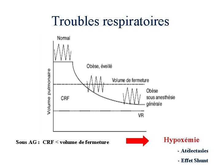 Troubles respiratoires Sous AG : CRF < volume de fermeture Hypoxémie - Atélectasies -