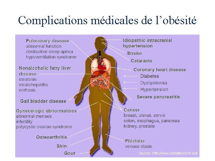 Complications médicales de l’obésité 