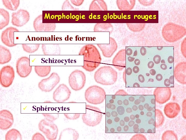 Morphologie des globules rouges § Anomalies de forme ü ü Schizocytes Sphérocytes 