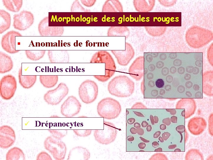 Morphologie des globules rouges § Anomalies de forme ü Cellules cibles ü Drépanocytes 