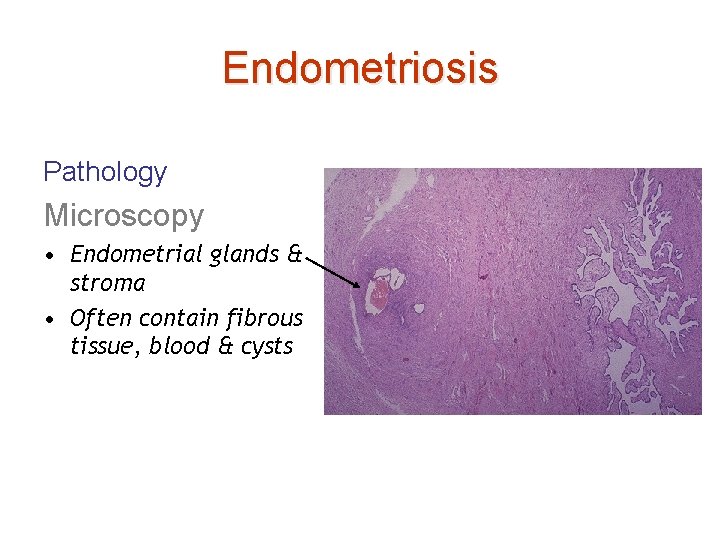 Endometriosis Pathology Microscopy • Endometrial glands & stroma • Often contain fibrous tissue, blood