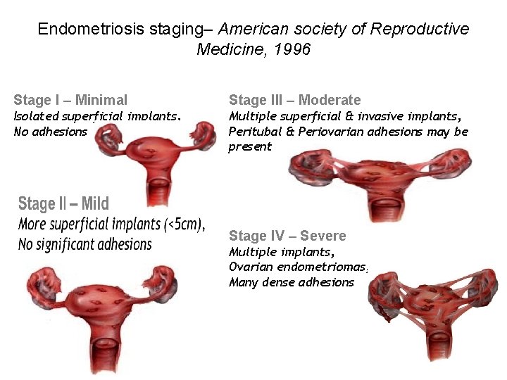 Endometriosis staging– American society of Reproductive Medicine, 1996 Stage I – Minimal Stage III