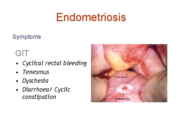 Endometriosis Symptoms GIT • • Cyclical rectal bleeding Tenesmus Dyschesia Diarrhoea/ Cyclic constipation 