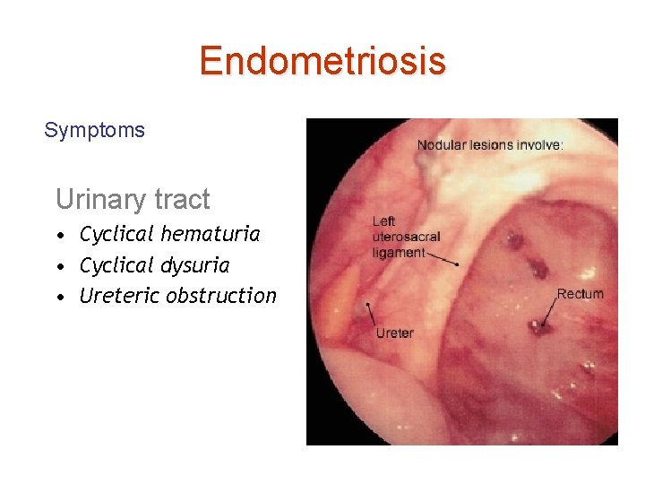 Endometriosis Symptoms Urinary tract • Cyclical hematuria • Cyclical dysuria • Ureteric obstruction 