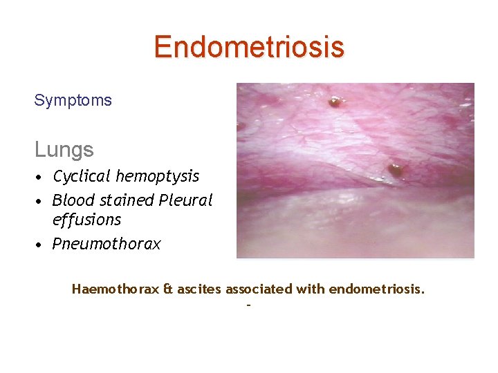 Endometriosis Symptoms Lungs • Cyclical hemoptysis • Blood stained Pleural effusions • Pneumothorax Haemothorax