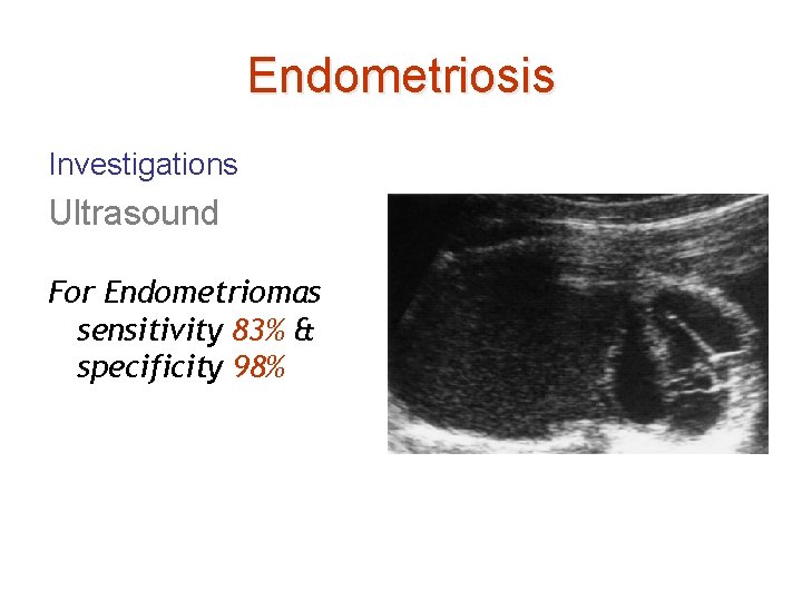 Endometriosis Investigations Ultrasound For Endometriomas sensitivity 83% & specificity 98% 