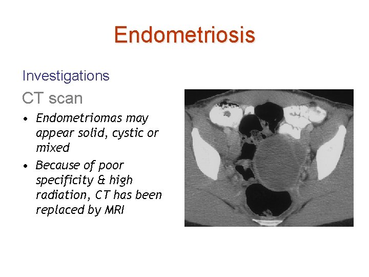 Endometriosis Investigations CT scan • Endometriomas may appear solid, cystic or mixed • Because
