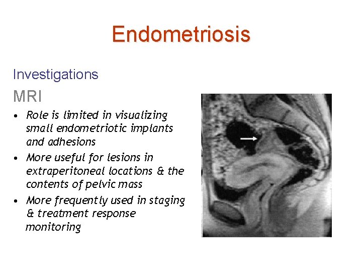 Endometriosis Investigations MRI • Role is limited in visualizing small endometriotic implants and adhesions