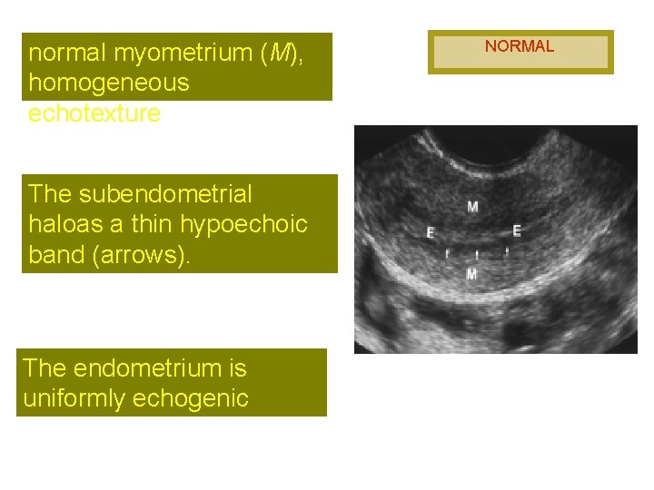 normal myometrium (M), homogeneous echotexture The subendometrial haloas a thin hypoechoic band (arrows). The