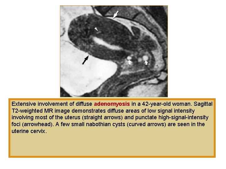 Extensive involvement of diffuse adenomyosis in a 42 -year-old woman. Sagittal T 2 -weighted